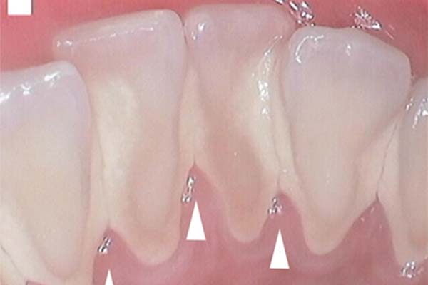 hawthorn gingivitis
